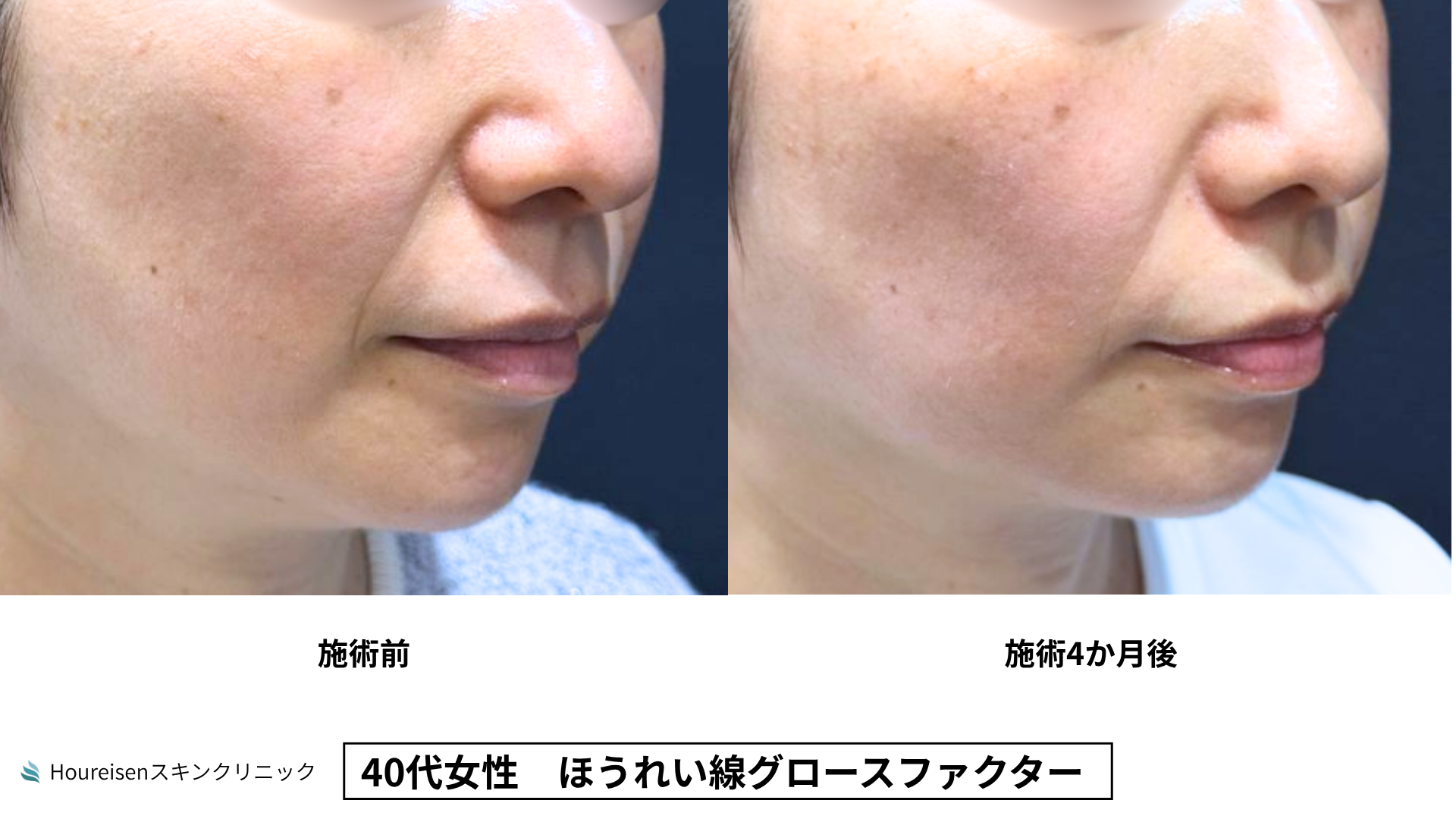 40代女性 ほうれい線グロースファクター4か月後 症例比較