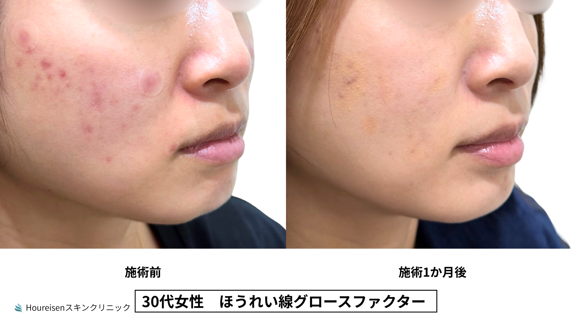 30代女性 ほうれい線グロースファクター症例比較