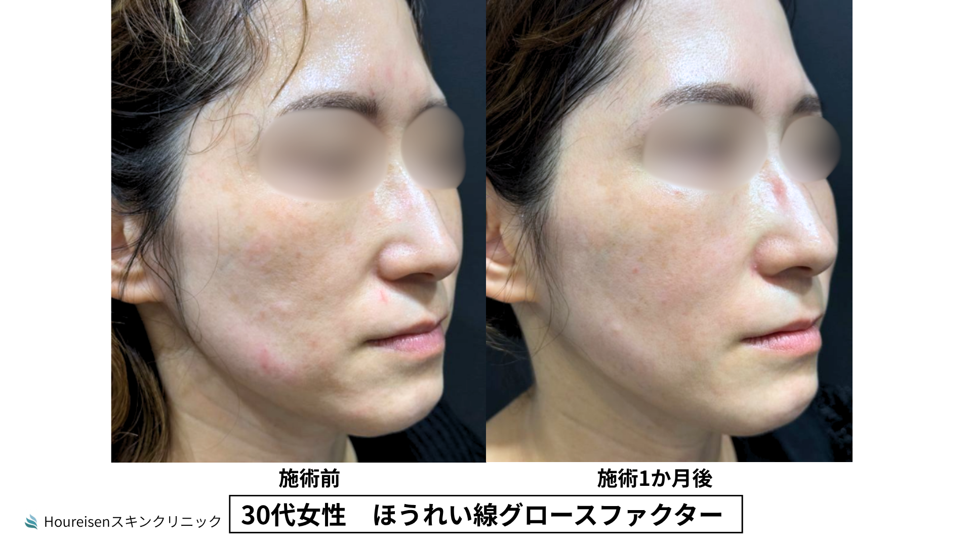 30代女性 グロースファクター3か月後 症例比較