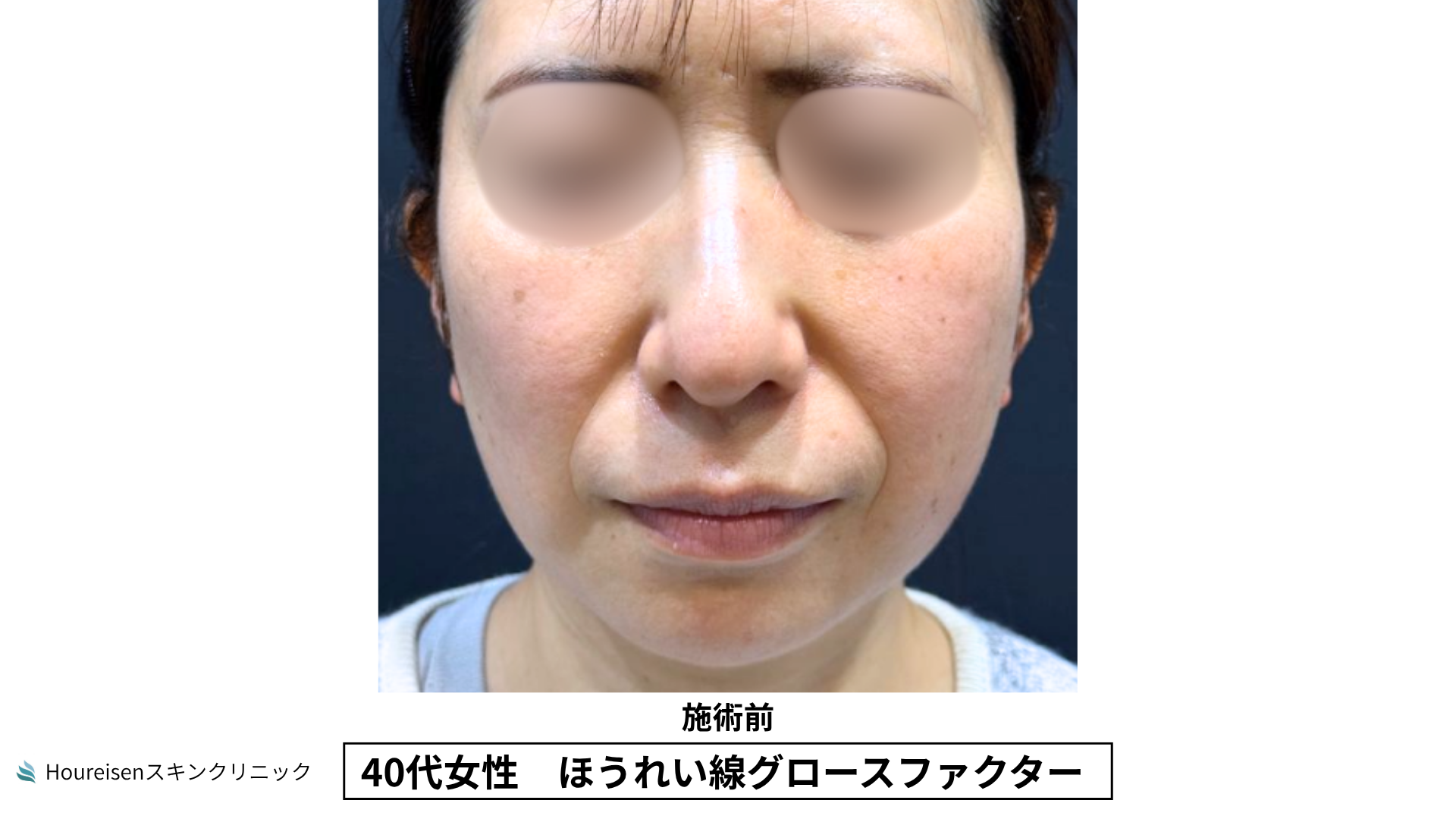 40代女性 ほうれい線グロースファクター施術前