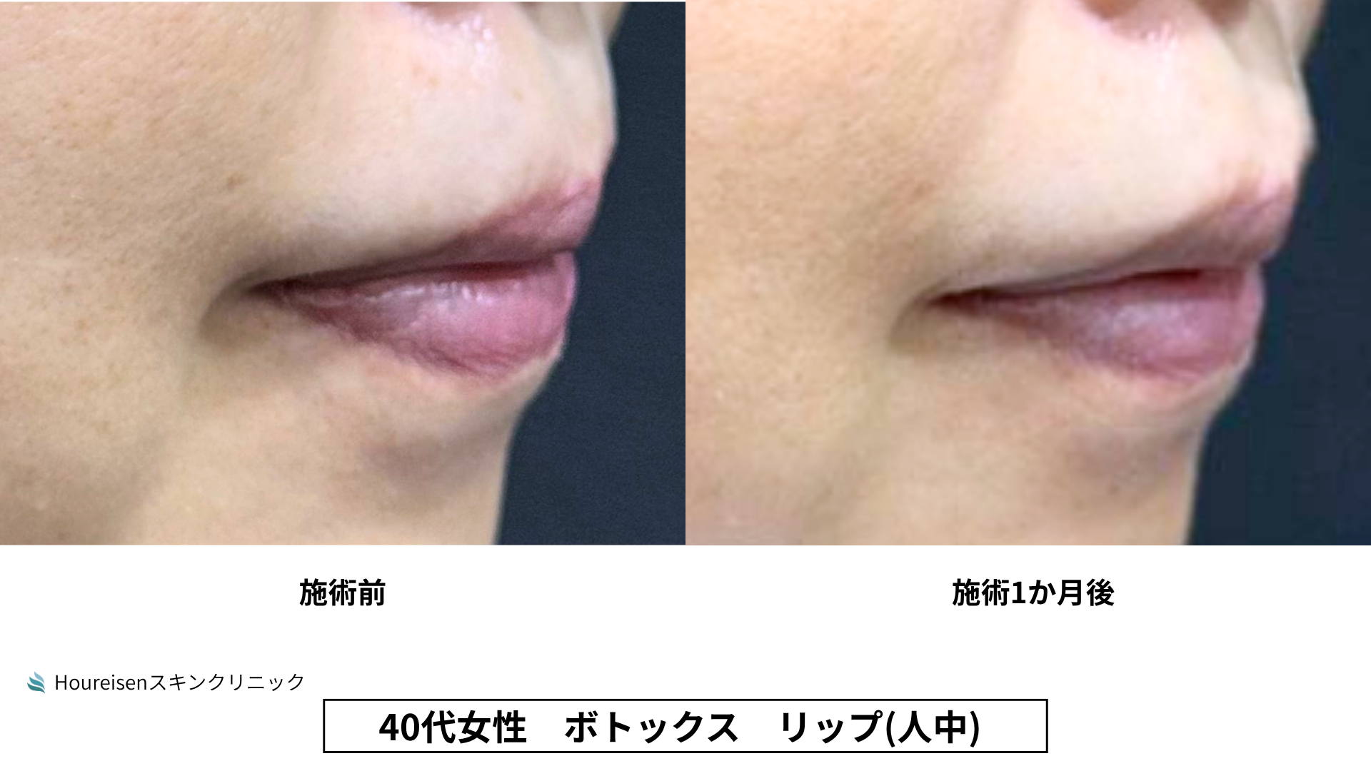 40代女性 リップ人中ボトックス 症例比較