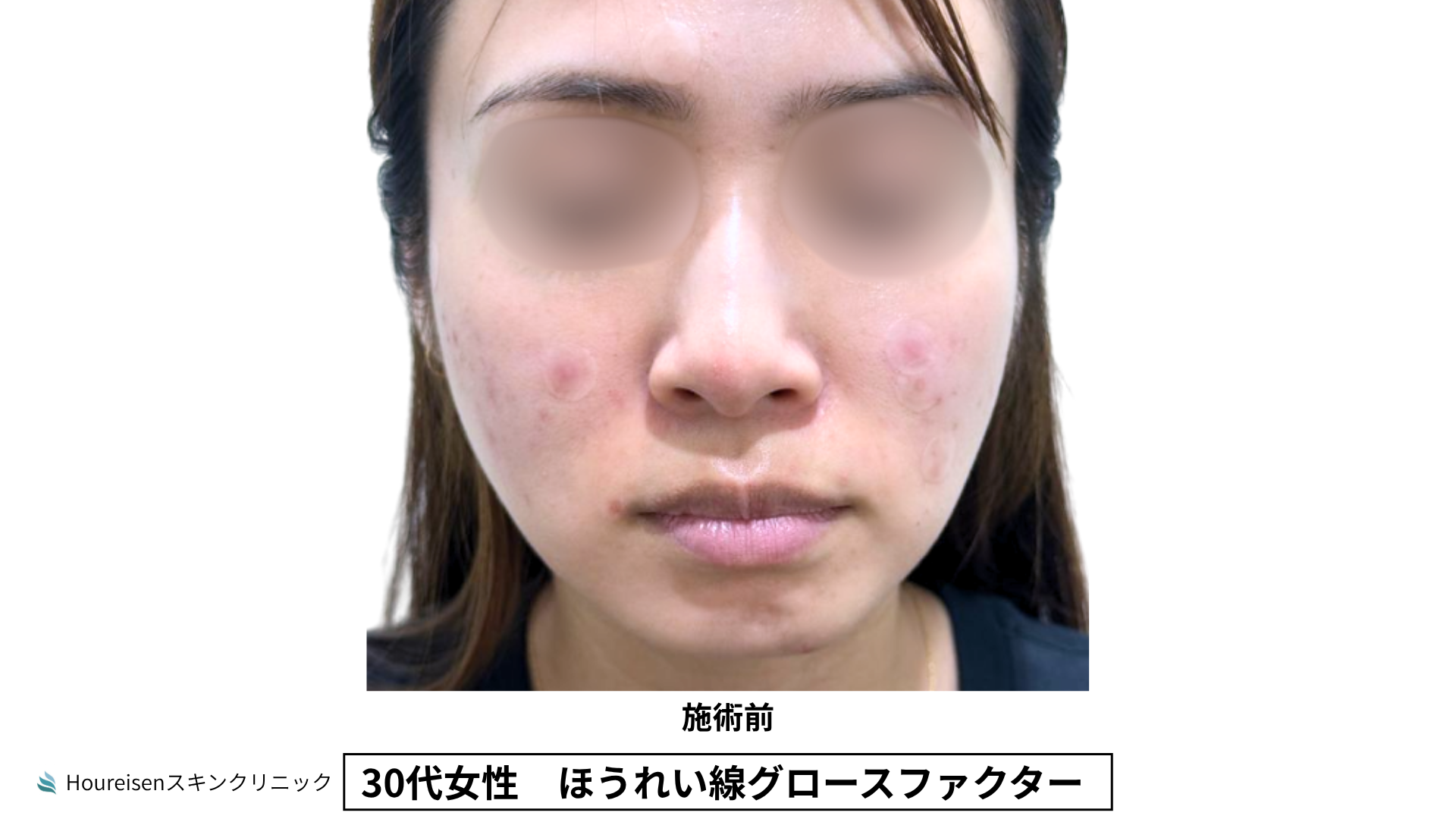 30代女性 ほうれい線グロースファクター施術前