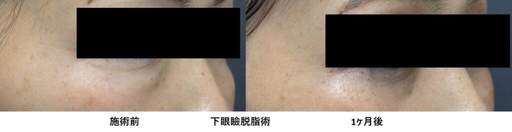 40代女性 目の下のクマ取り 下眼瞼脱脂術 施術前と1か月後 右側比較