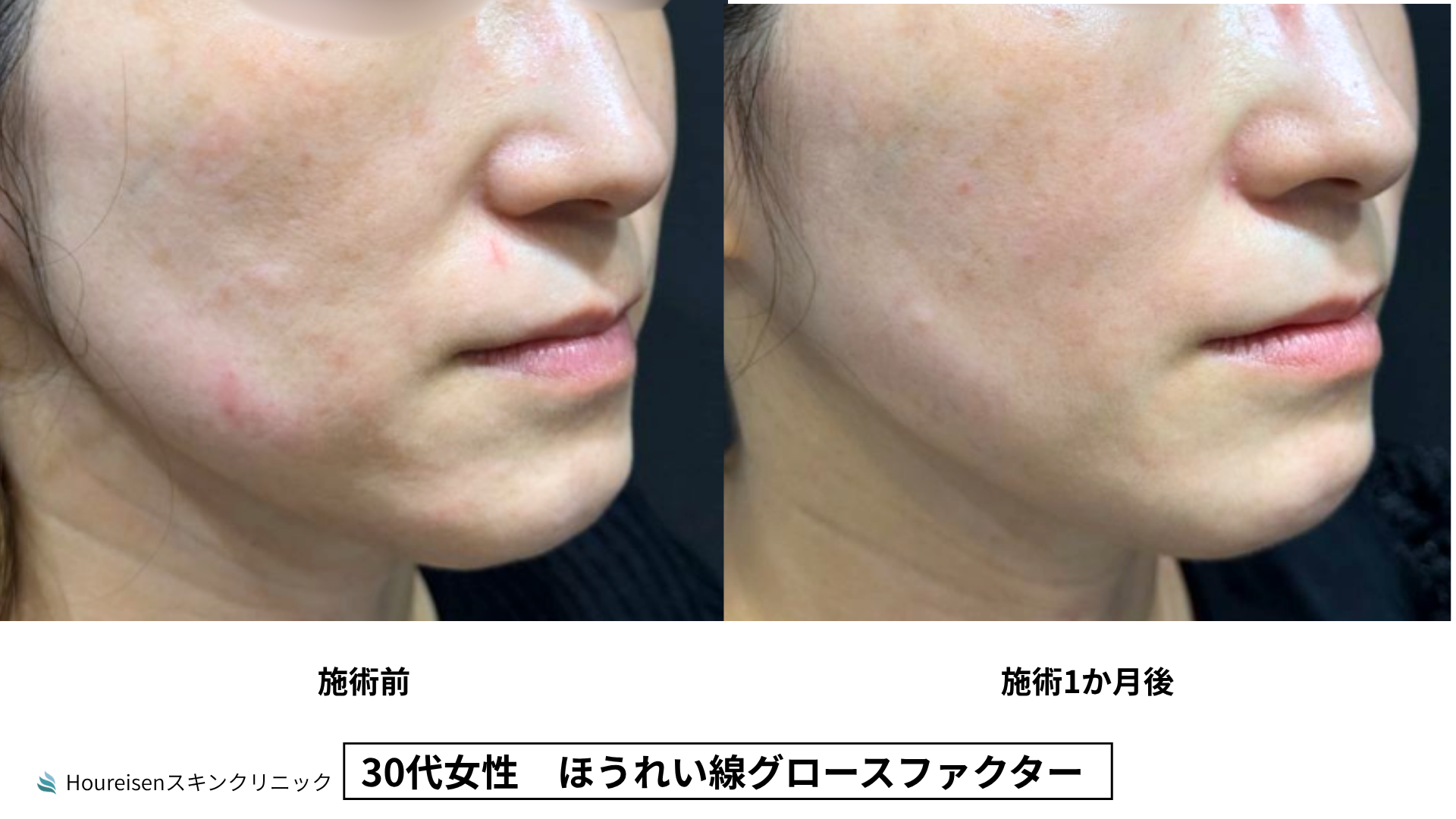 30代女性 グロースファクター3か月後 症例比較