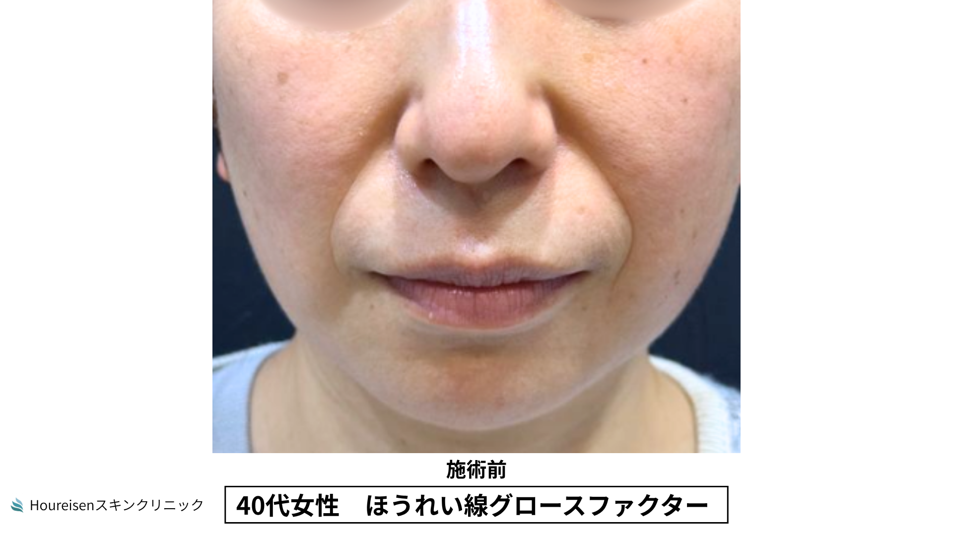 40代女性 ほうれい線グロースファクター施術前
