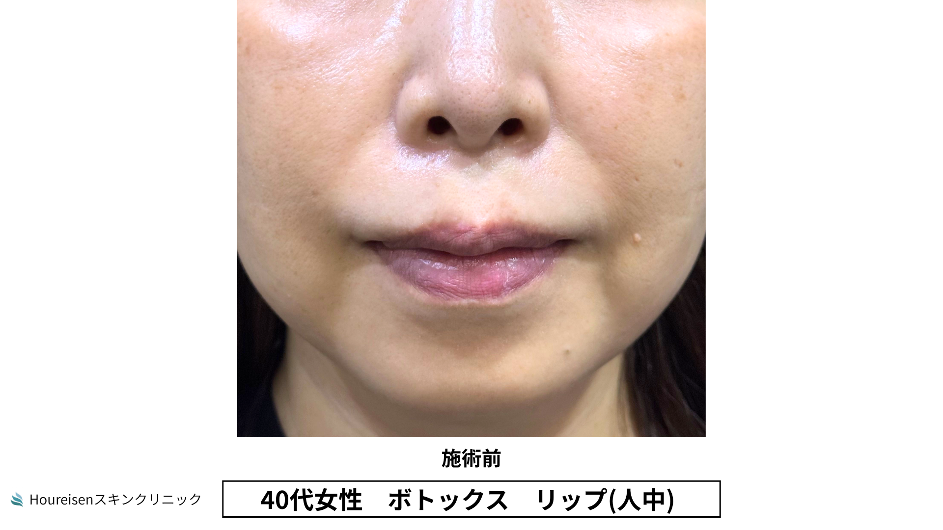 40代女性 リップ人中ボトックス 治療前