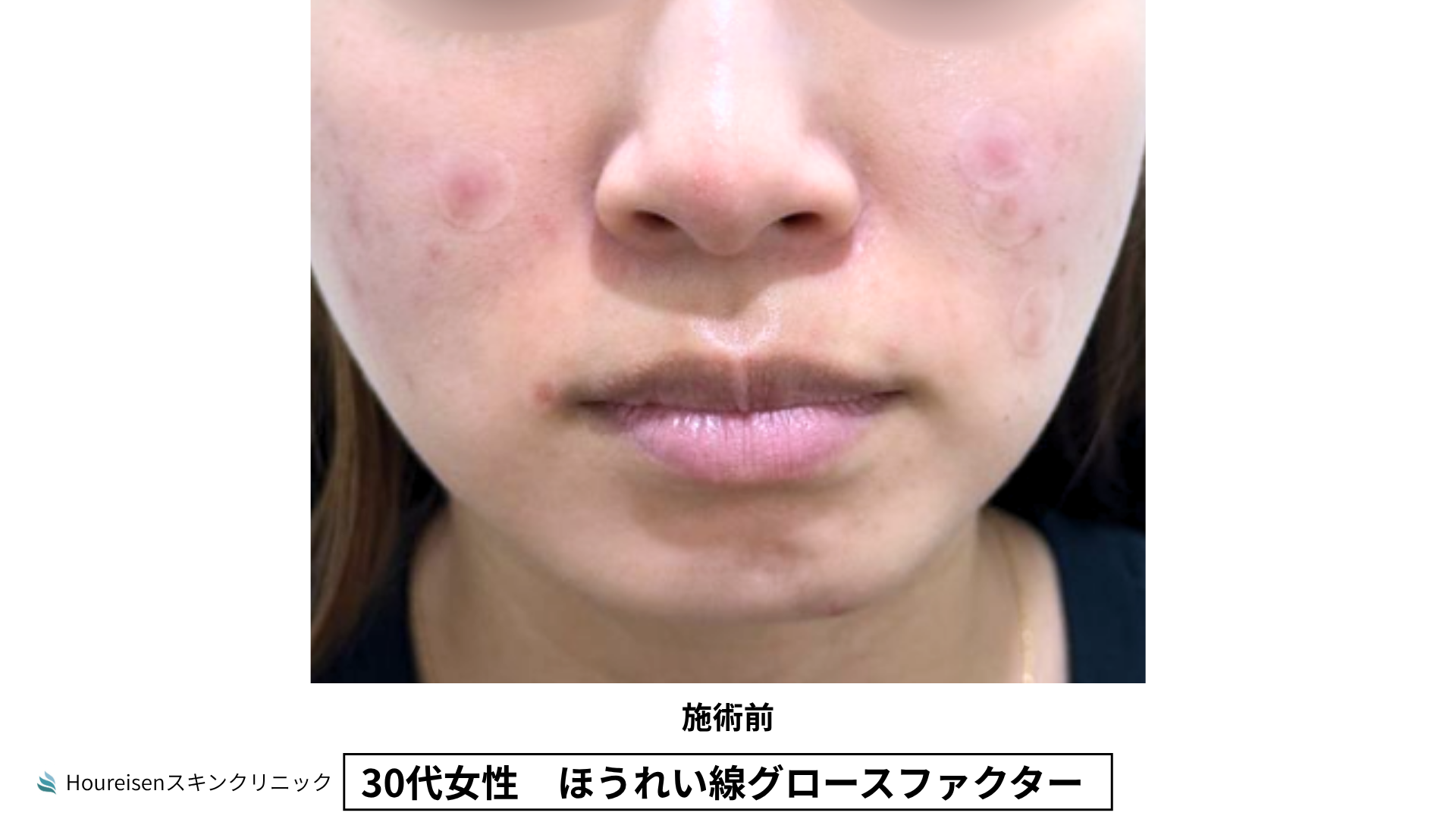 30代女性 ほうれい線グロースファクター施術前