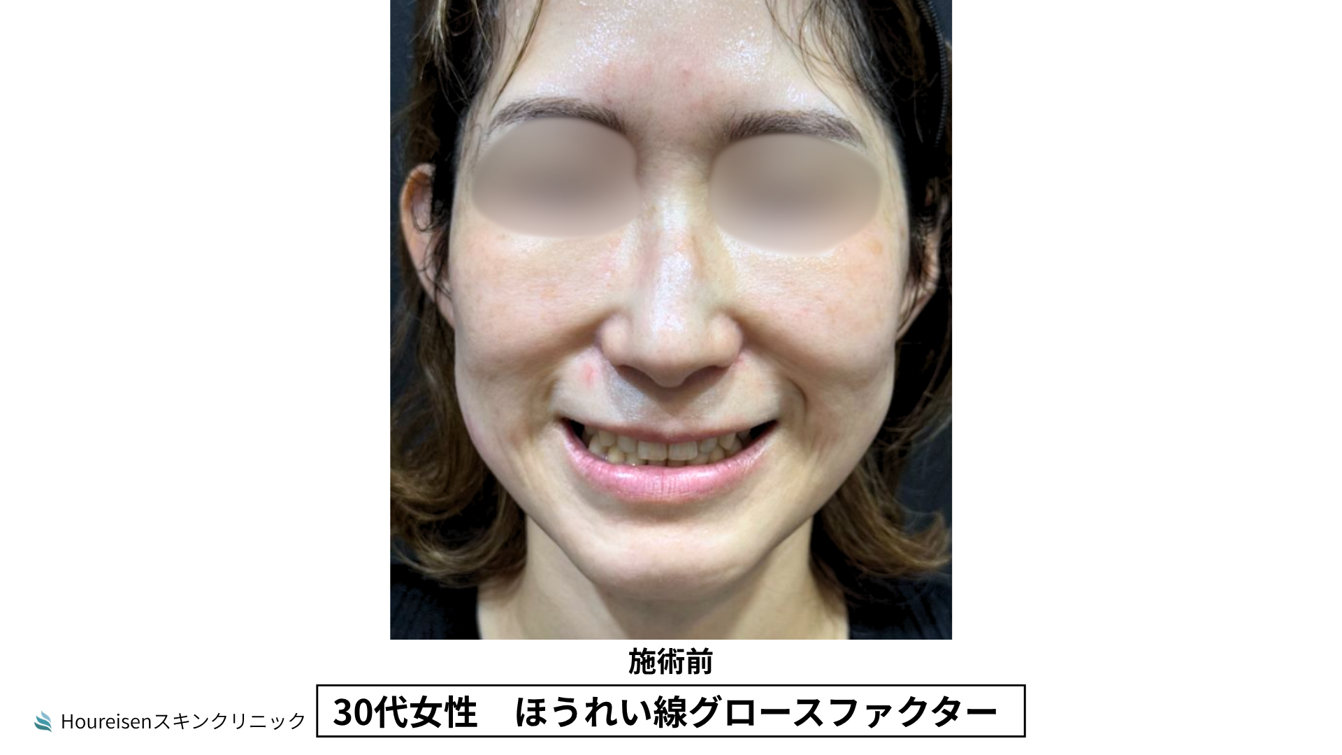 30代女性 ほうれい線グロースファクター施術前