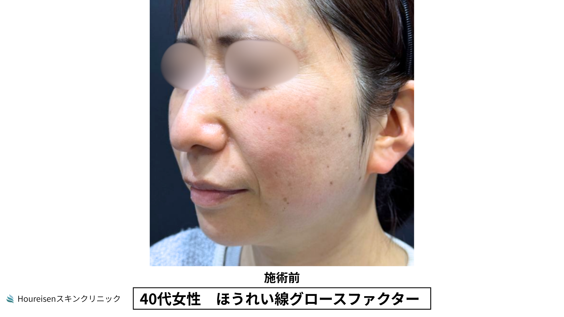 40代女性 ほうれい線グロースファクター施術前