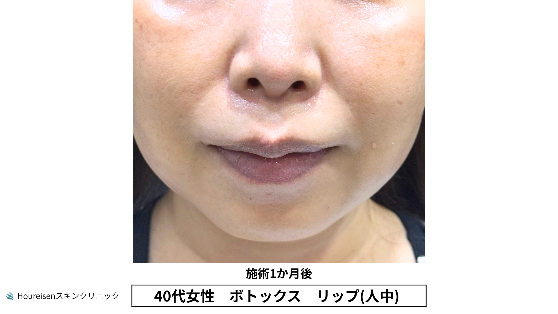 40代女性 リップ人中ボトックス 治療1か月後