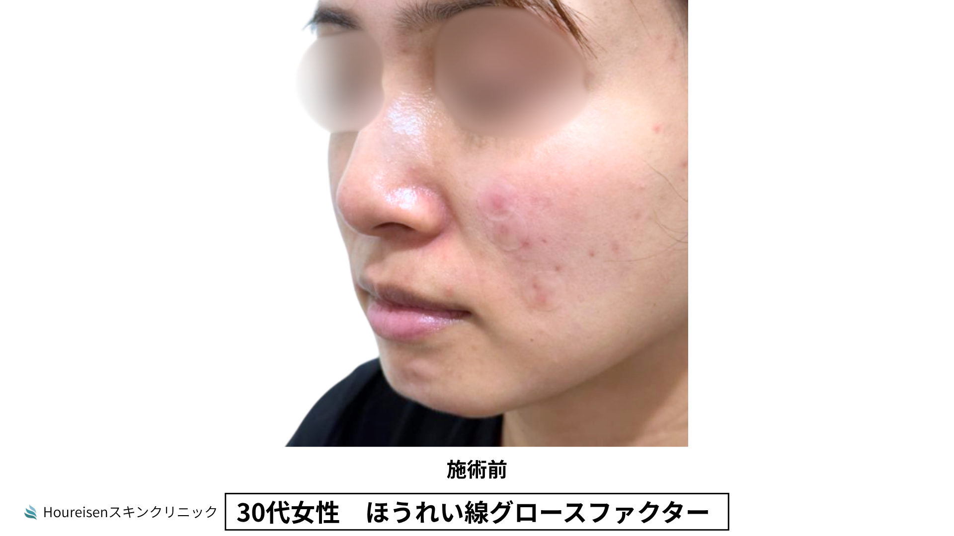 30代女性 ほうれい線グロースファクター施術前