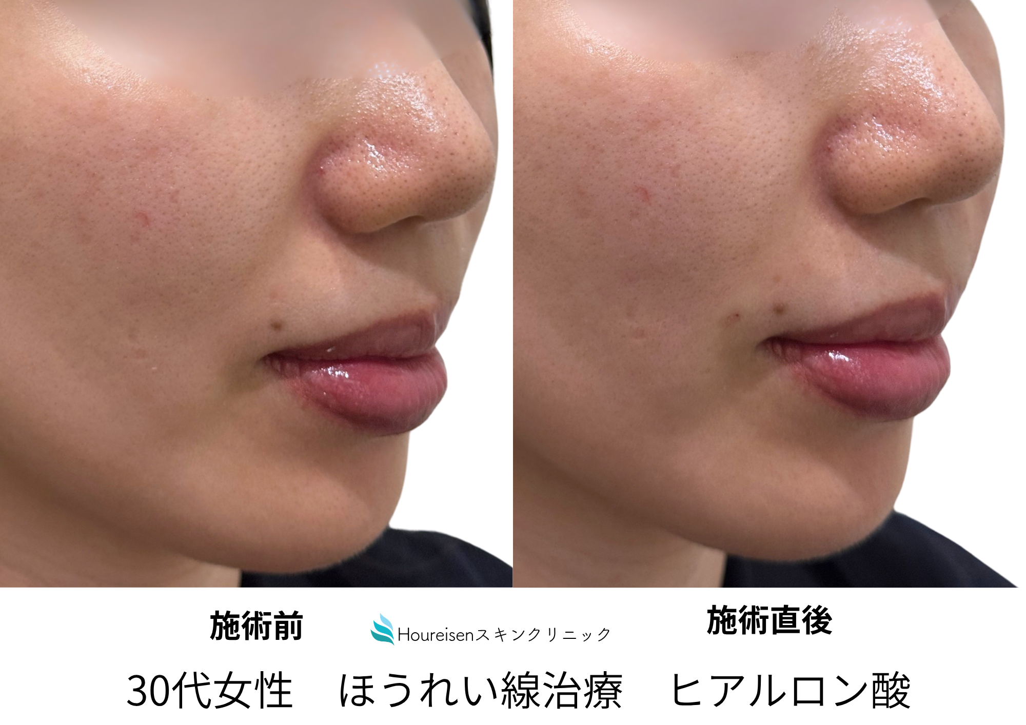 30代女性のほうれい線ヒアルロン酸注射症例