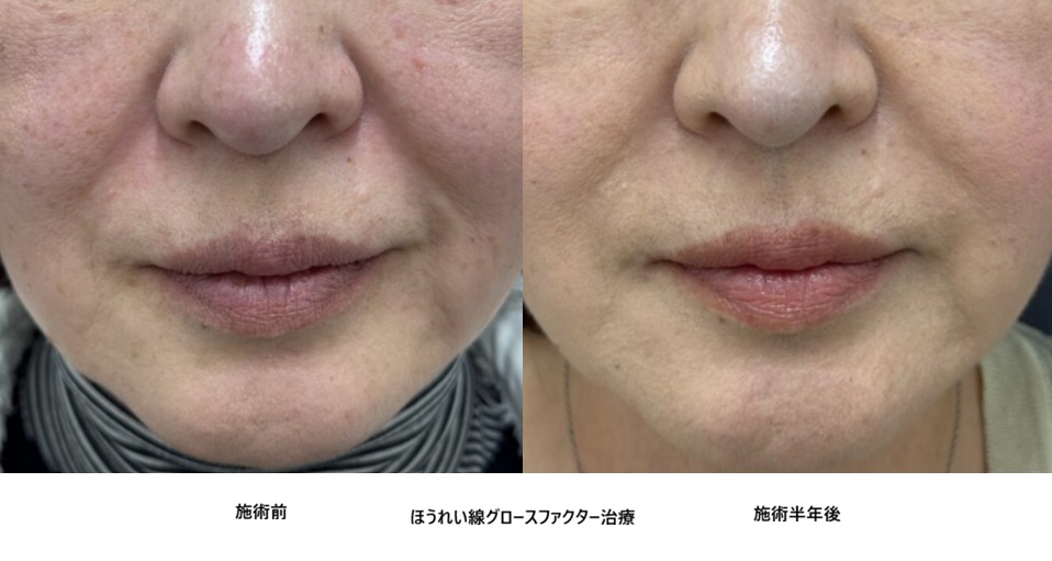 50代女性・症例56のほうれい線治療写真