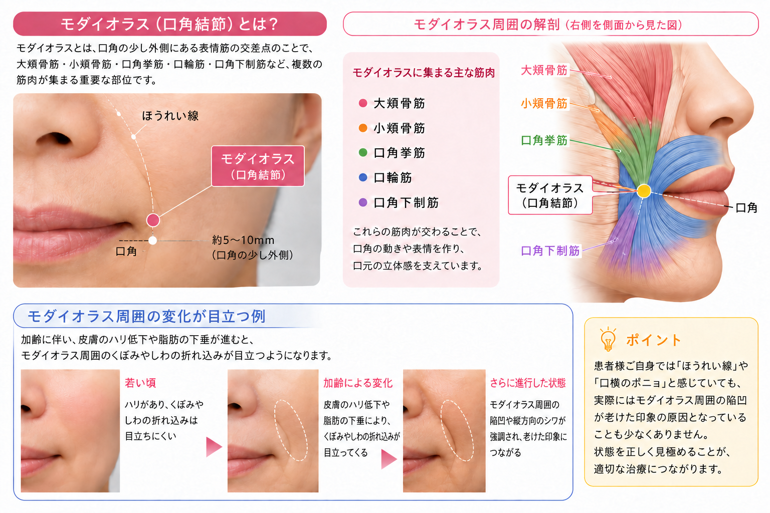 モダイオラス(口角結節)の位置と周囲のしわの折れ込みを説明する図